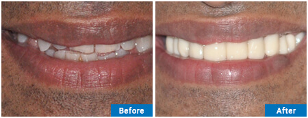 CROWN BRIDGE VEENERS